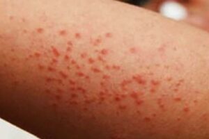 Morelos detecta 13 casos importados de sarampión; suman 5 mil a nivel nacional