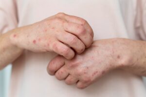 México registra el primer deceso por sarampión en 2026